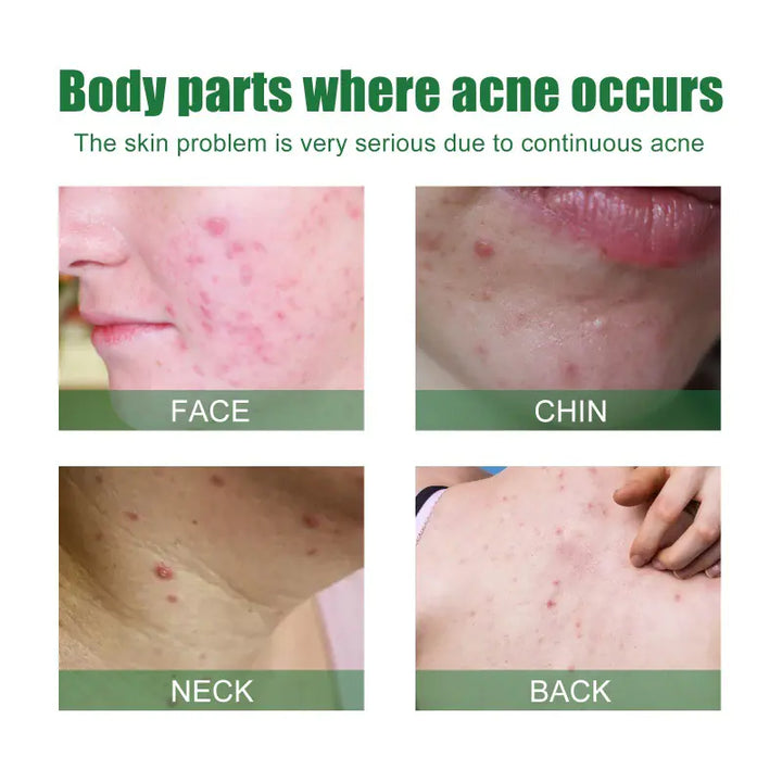 OUHOE Anti-Acne Facial Serum for Oil Control and Pores
